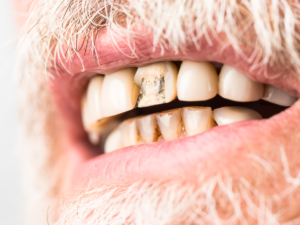 Up-close image of an older man's rotten teeth.